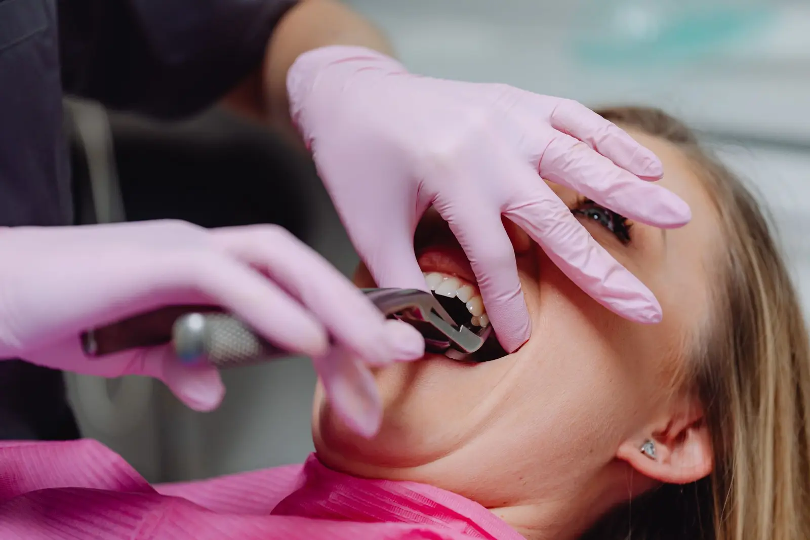 Tooth Extraction at AM Denturologiste dental clinic in Sainte-Julie