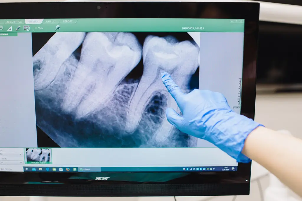 Wisdom Teeth Extraction — dental care in Sainte-Julie