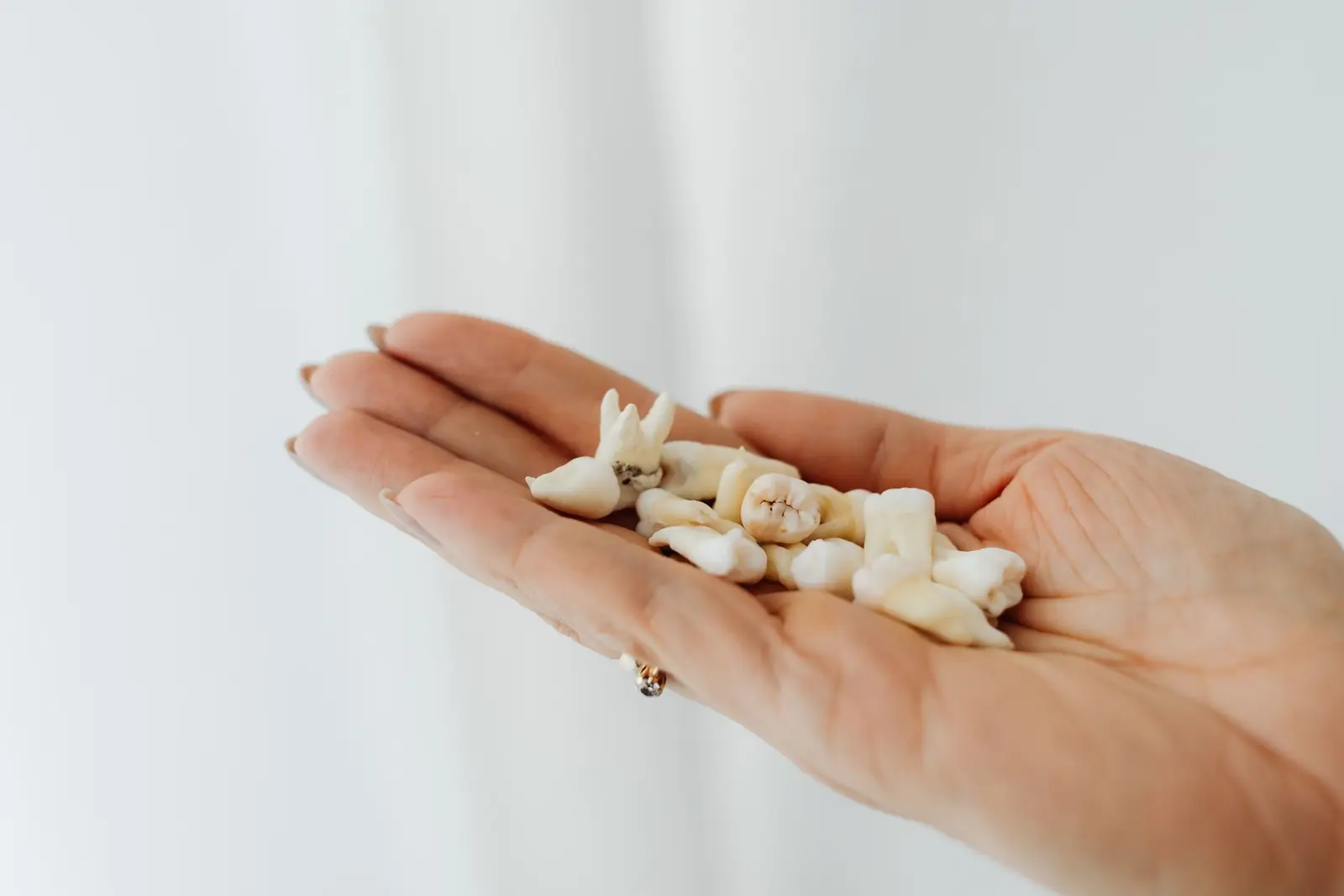 Wisdom Teeth Extraction at AM Denturologiste dental clinic in Sainte-Julie