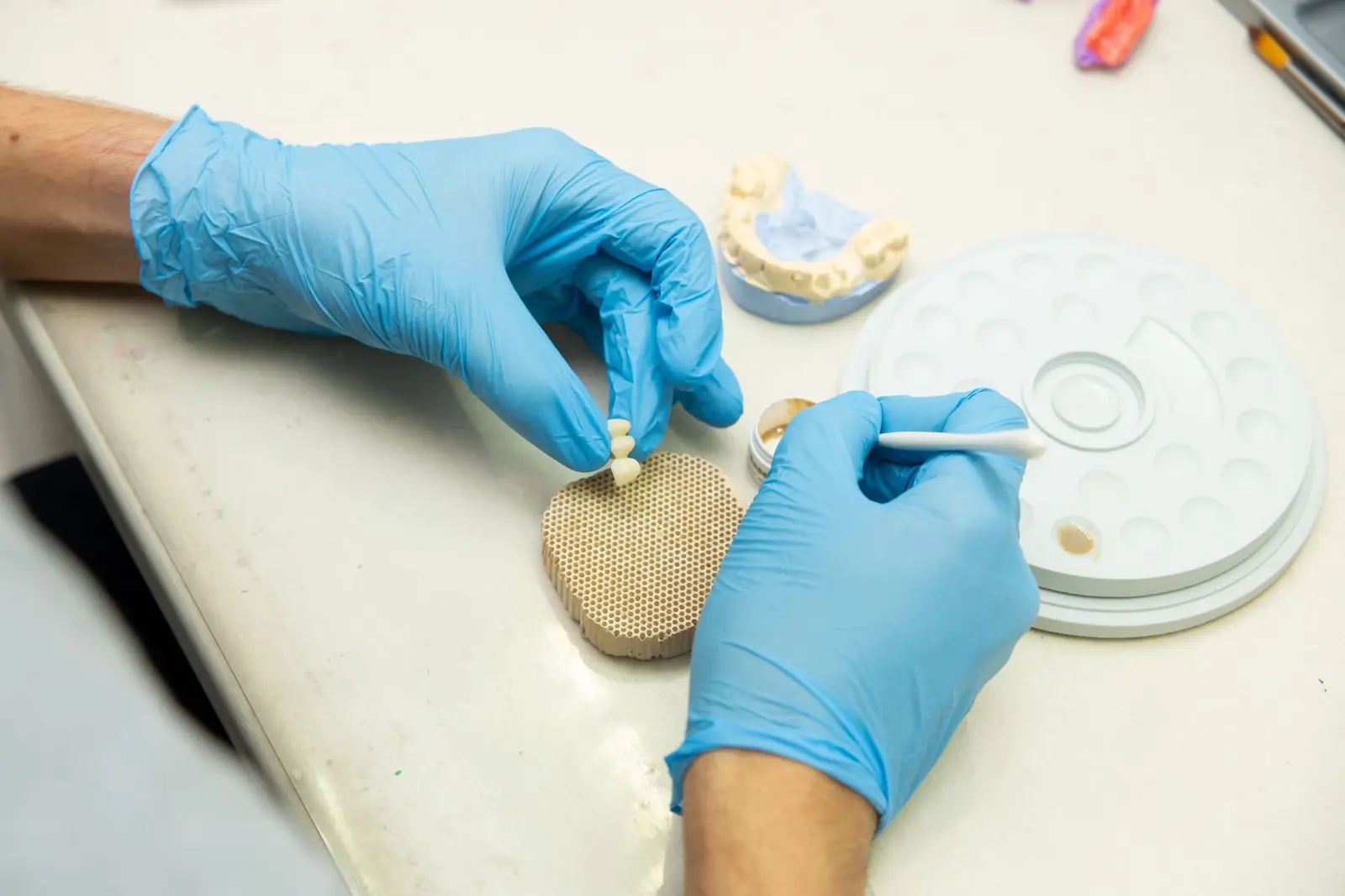 Dental Inlays and Onlays at AM Denturologiste dental clinic in Sainte-Julie