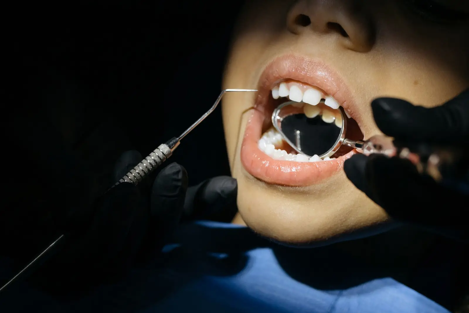 Cavity Treatment at AM Denturologiste dental clinic in Sainte-Julie