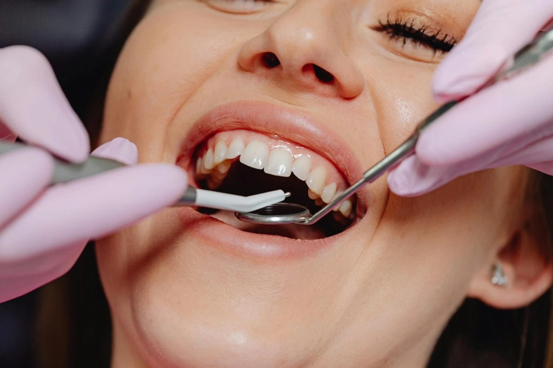Examen dentaire de routine avec miroir et sondes chez AM Denturologiste à Sainte-Julie