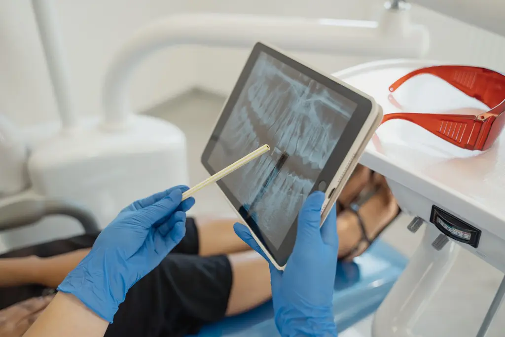 Root Canal Treatment and Endodontics — dental care in Sainte-Julie