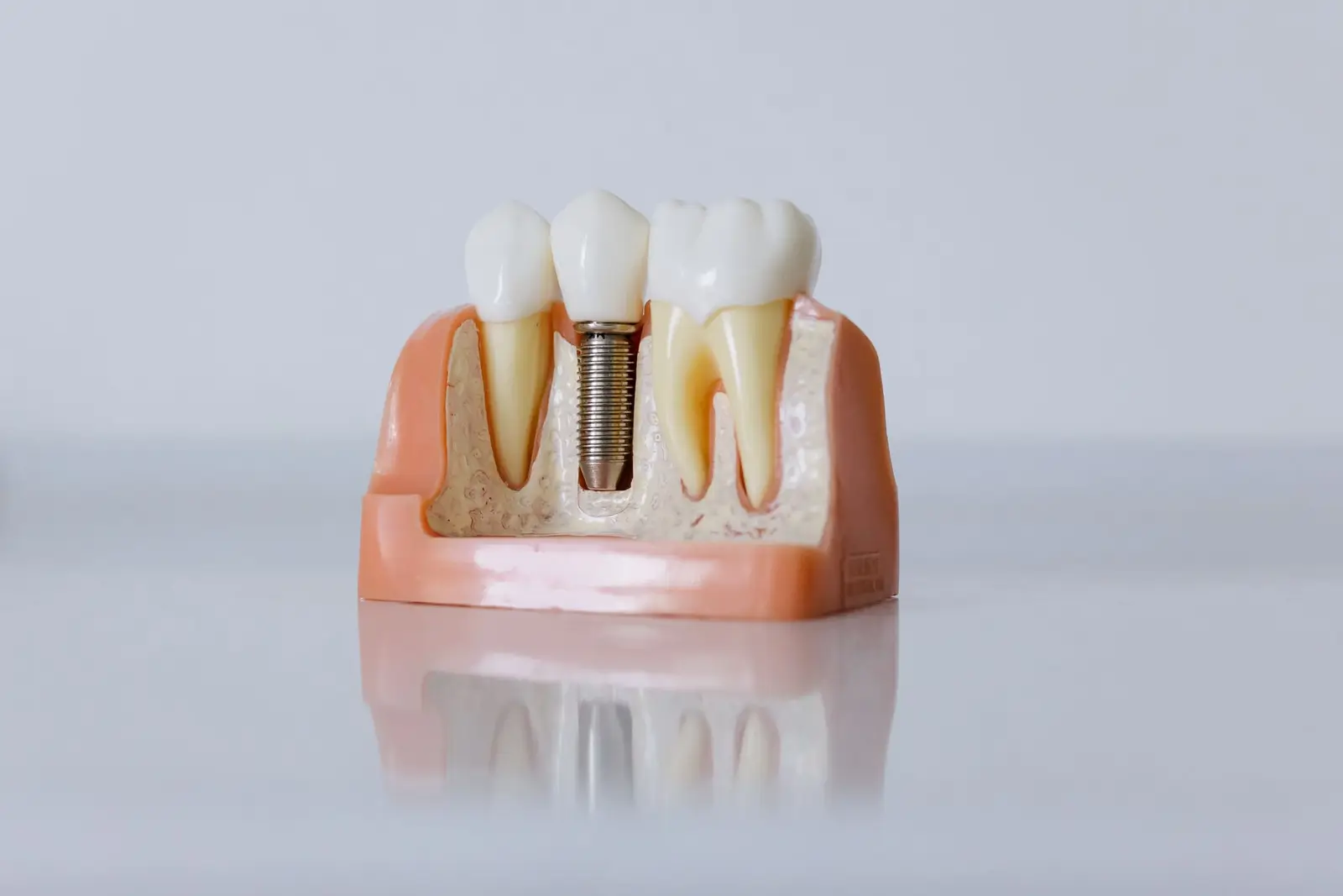 Dental Implants at AM Denturologiste dental clinic in Sainte-Julie
