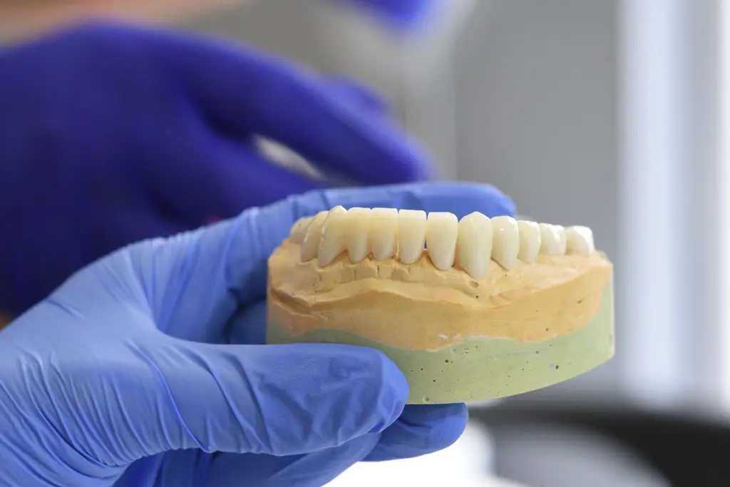 Implant Restorations — dental care in Sainte-Julie