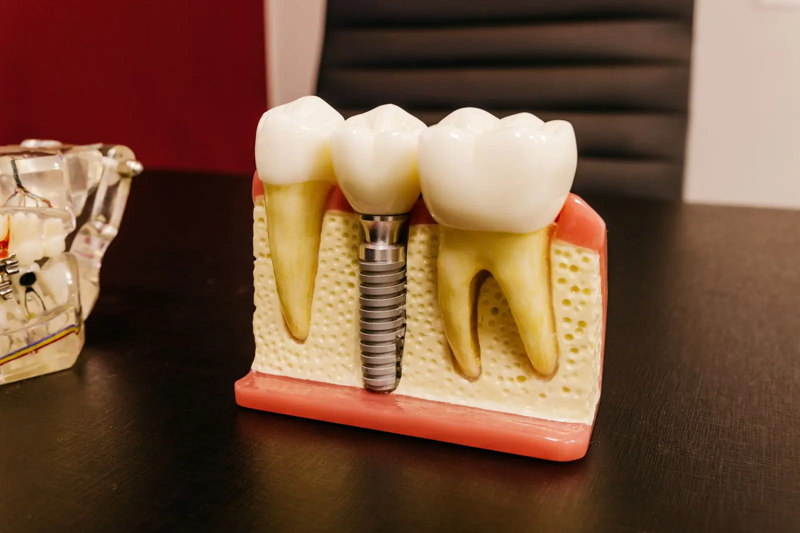 Implant Restorations at AM Denturologiste dental clinic in Sainte-Julie