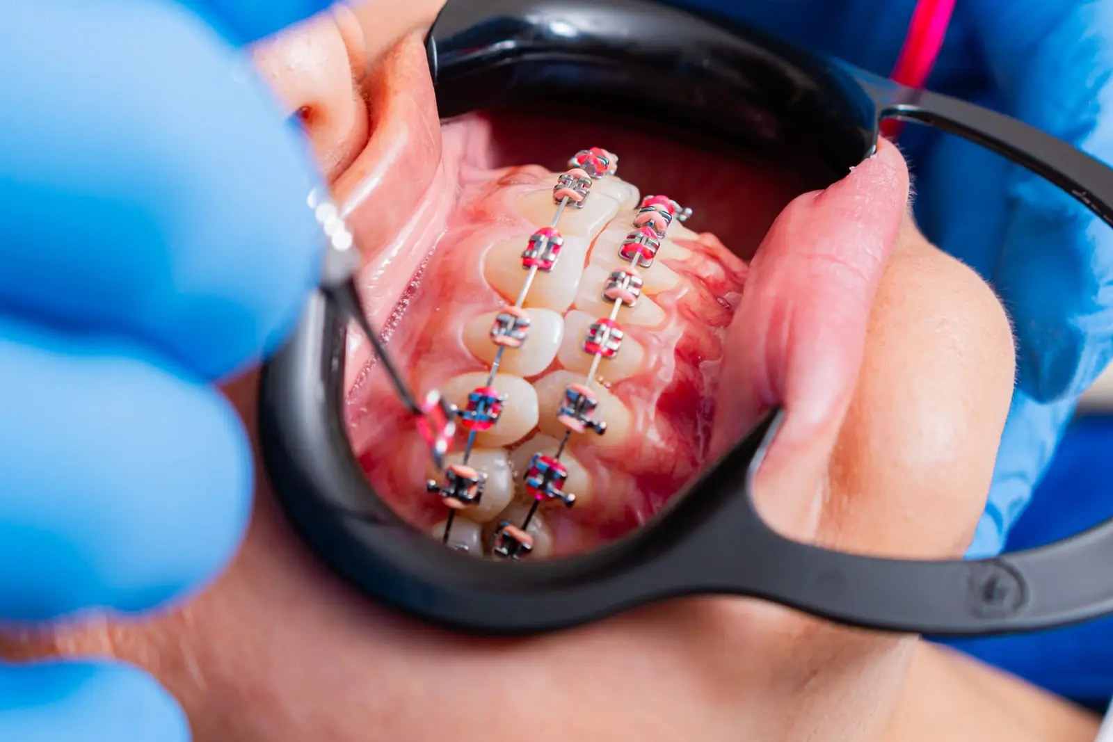Orthodontics at AM Denturologiste dental clinic in Sainte-Julie