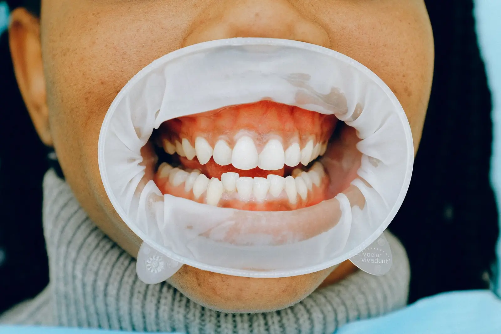 Periodontal Care at AM Denturologiste dental clinic in Sainte-Julie