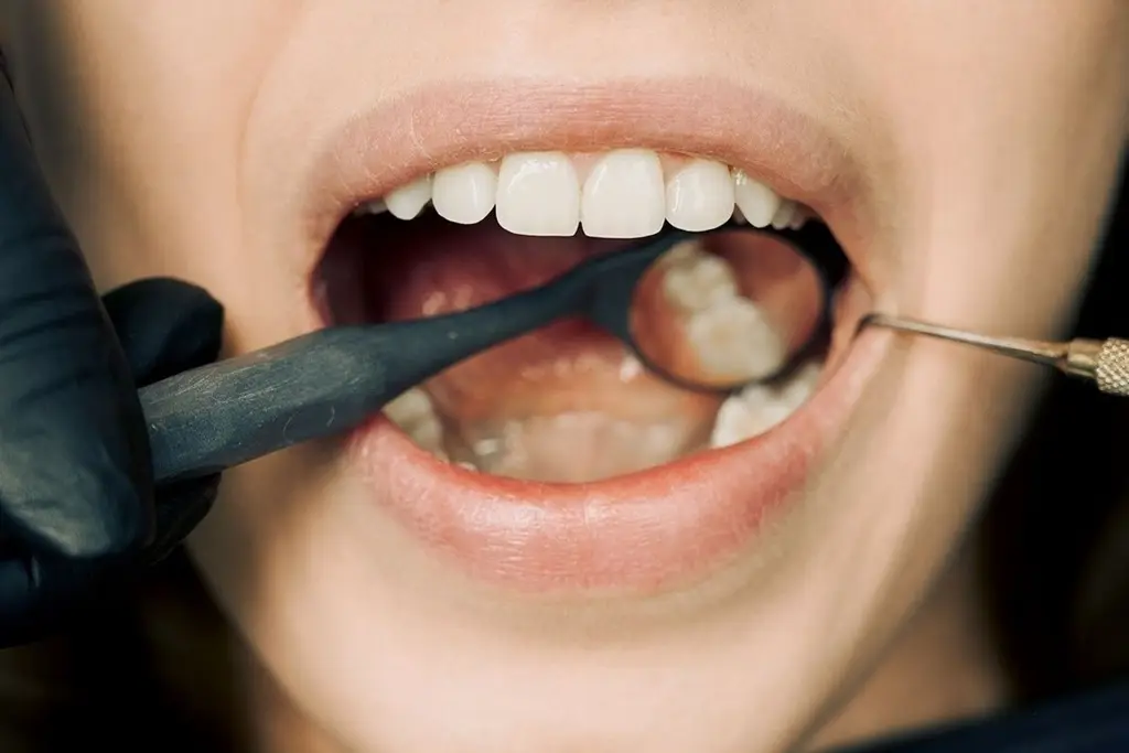 Gum Disease — dental care in Sainte-Julie