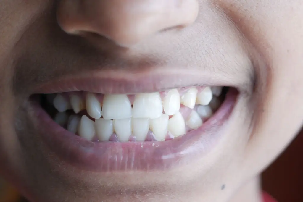 Dental Bruxism Treatment — dental care in Sainte-Julie